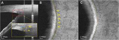 En face optical coherence tomography detection of Schlemm’s canal in primary open angle glaucoma